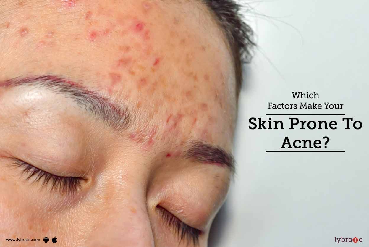 Which Factors Make Your Skin Prone To Acne?