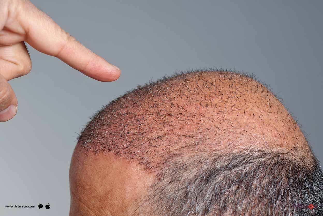 Hair Transplant - Things To Know!