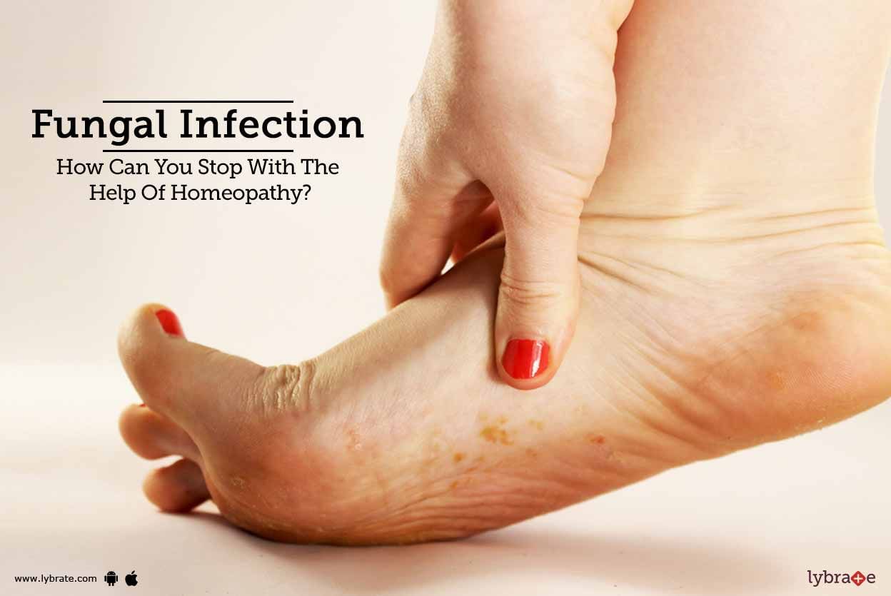 Fungal Infection: How Can You Stop with the Help of Homeopathy?