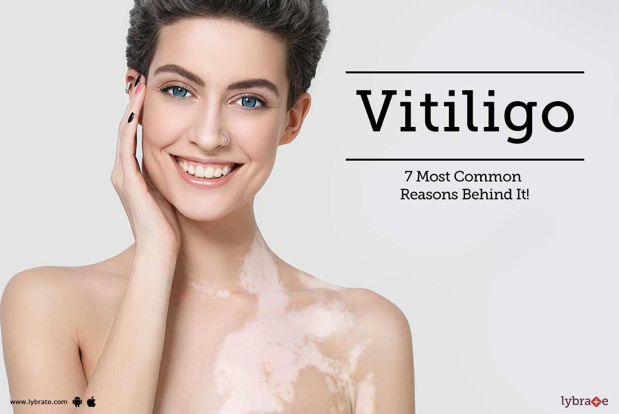 Vitiligo - 7 Most Common Reasons Behind It!