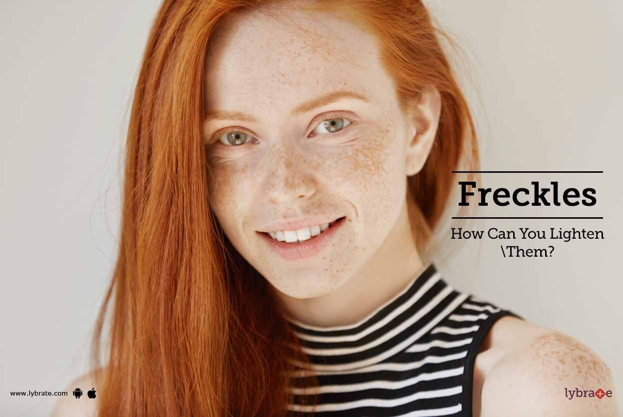 Freckles - How Can You Lighten Them?