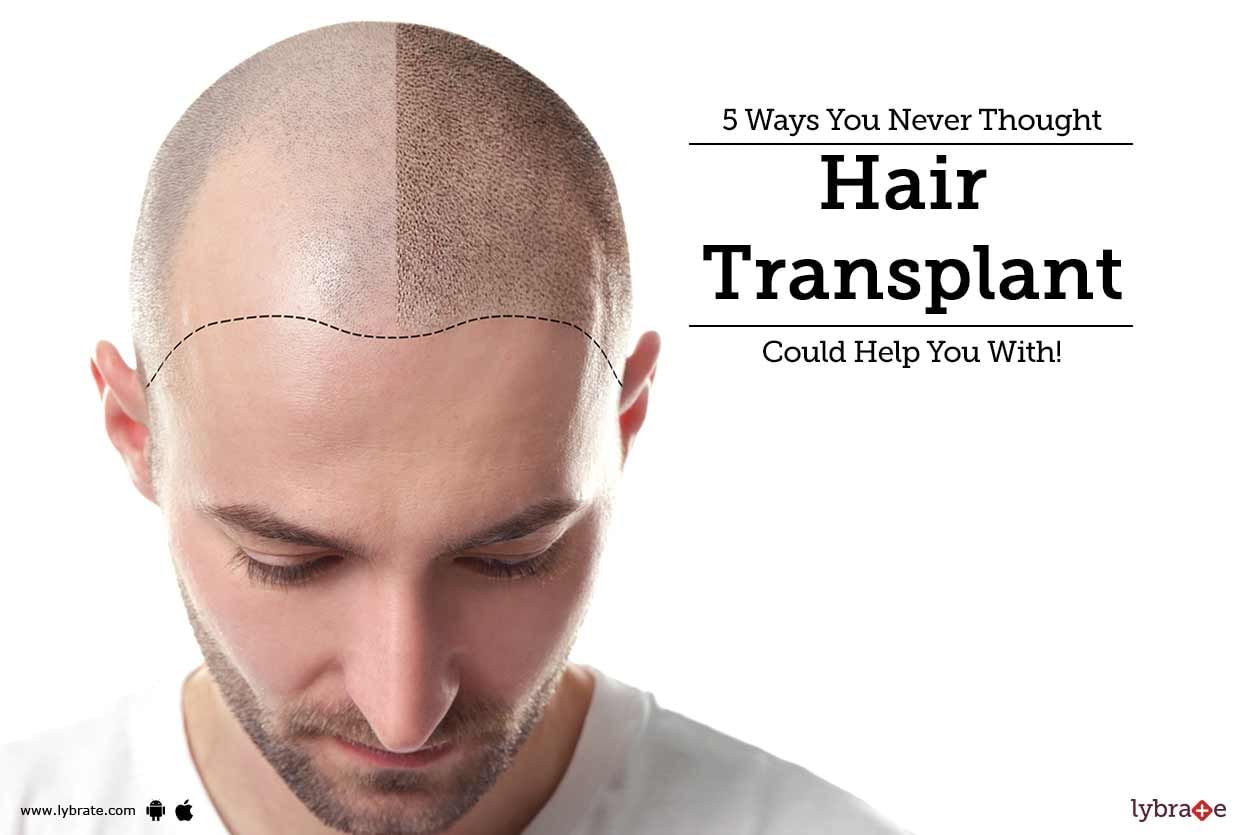 5 Ways You Never Thought Hair Transplant Could Help You With!
