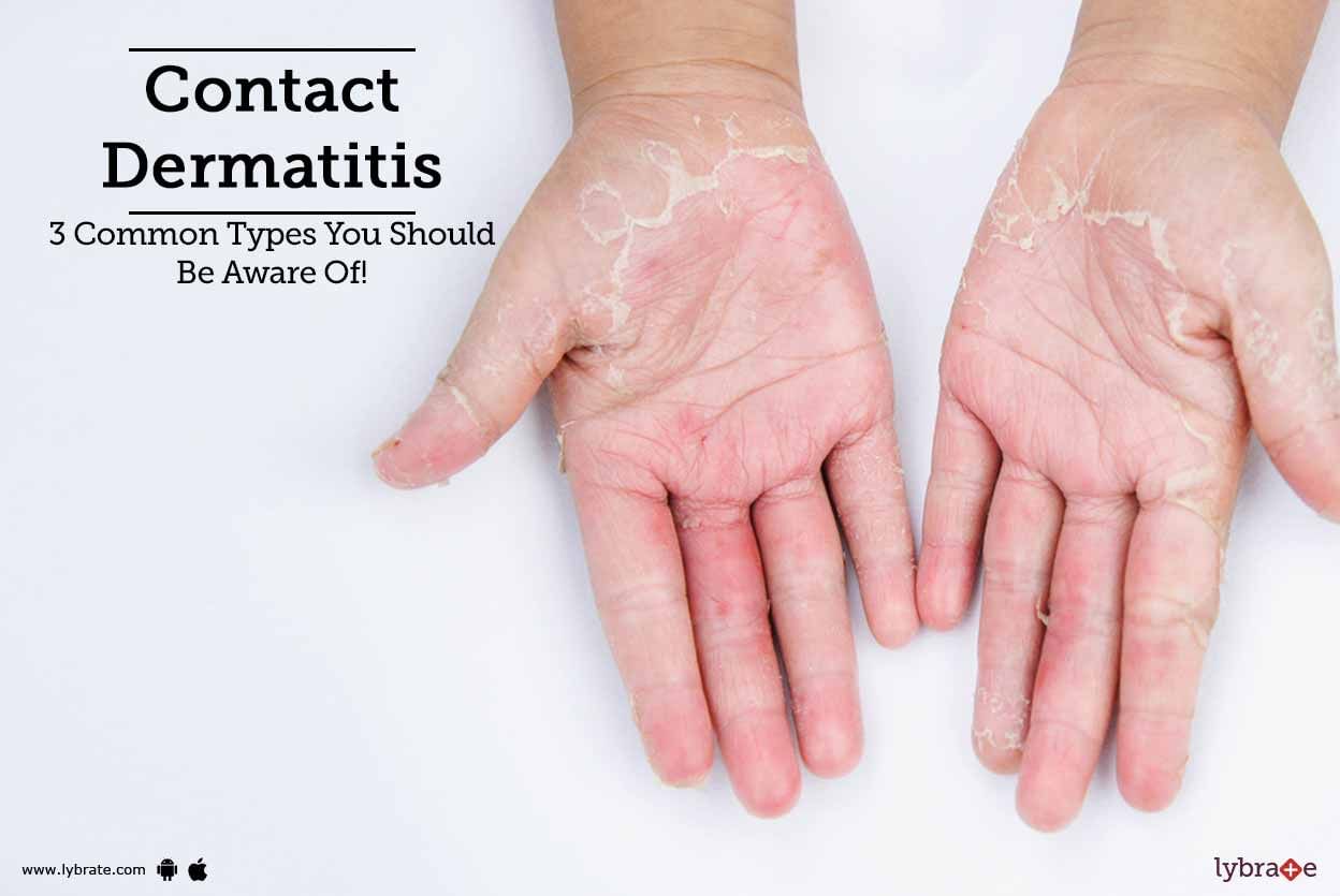 Contact Dermatitis - 3 Common Types You Should Be Aware Of!