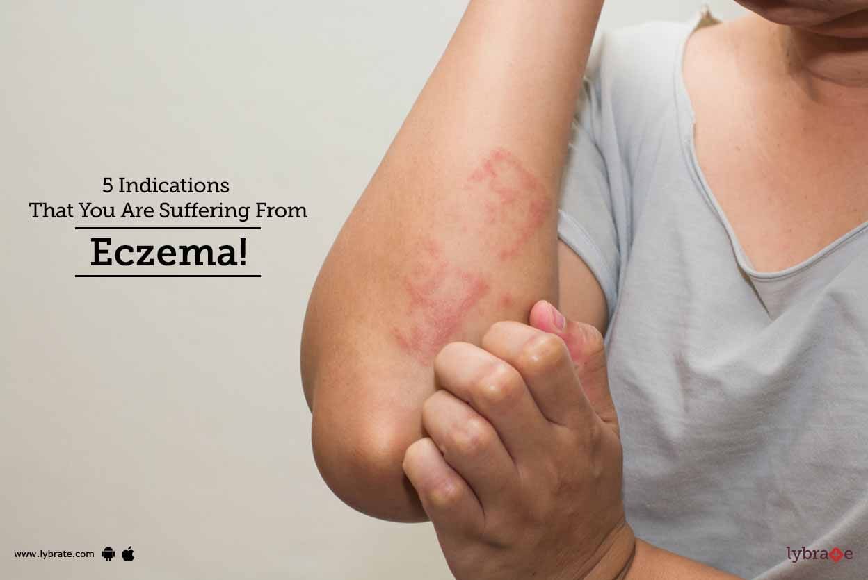5 Indications That You Are Suffering From Eczema!