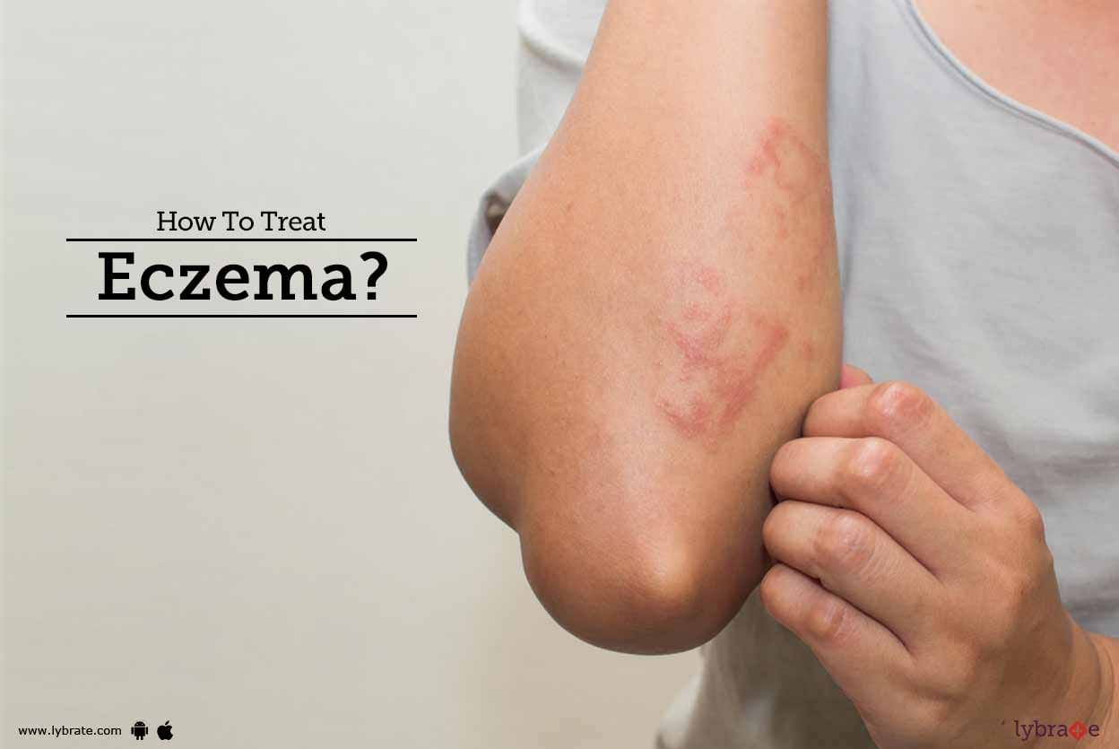 How To Treat Eczema?