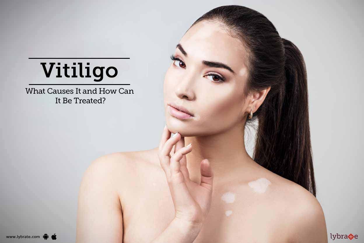 Vitiligo - What Causes It and How Can It Be Treated?