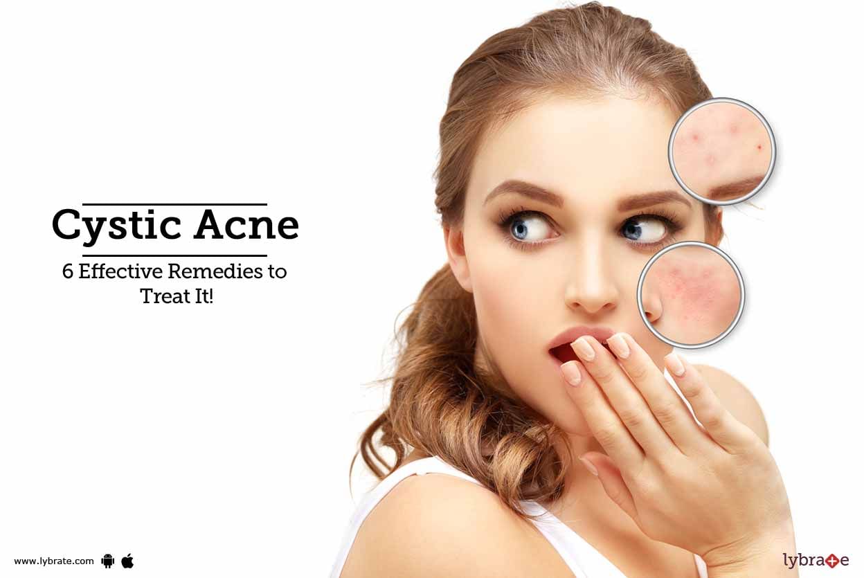 Cystic Acne - 6 Effective Remedies to Treat It!