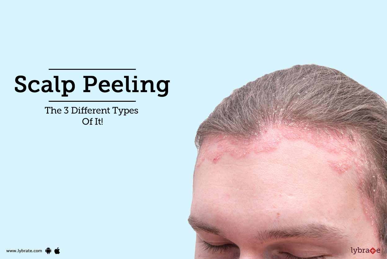 Scalp Peeling - The 3 Different Types Of It!