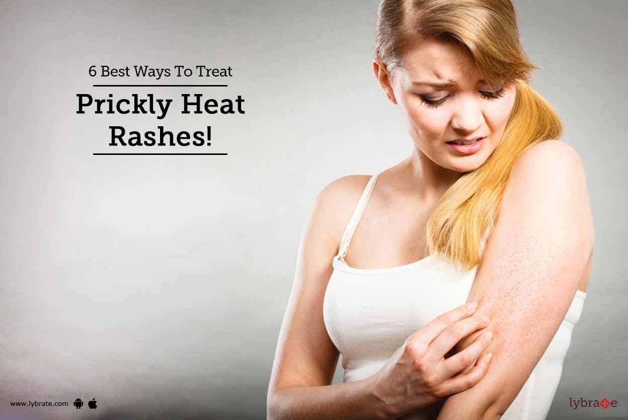 6 Best Ways To Treat Prickly Heat Rashes!