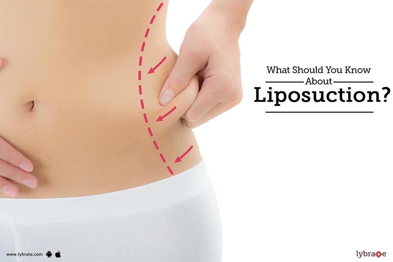What Should You Know About Liposuction?