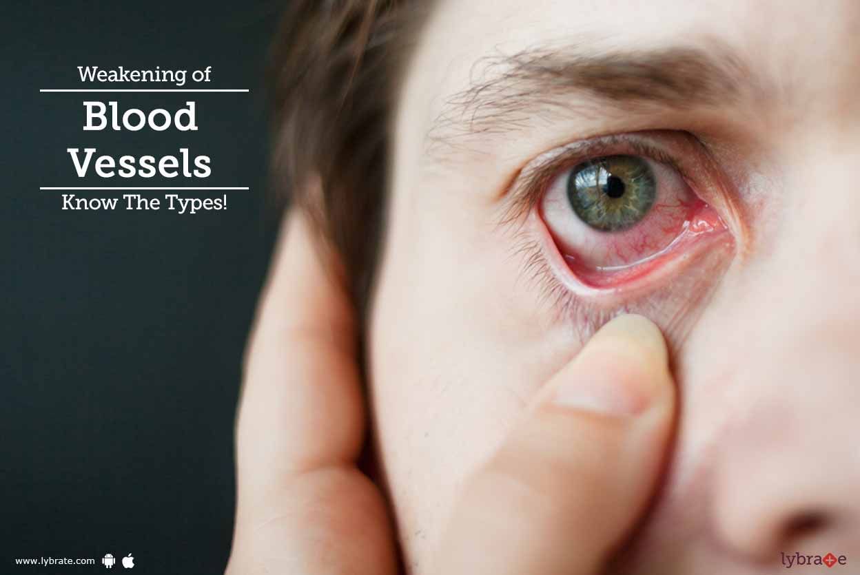 Weakening of Blood Vessels - Know The Types!