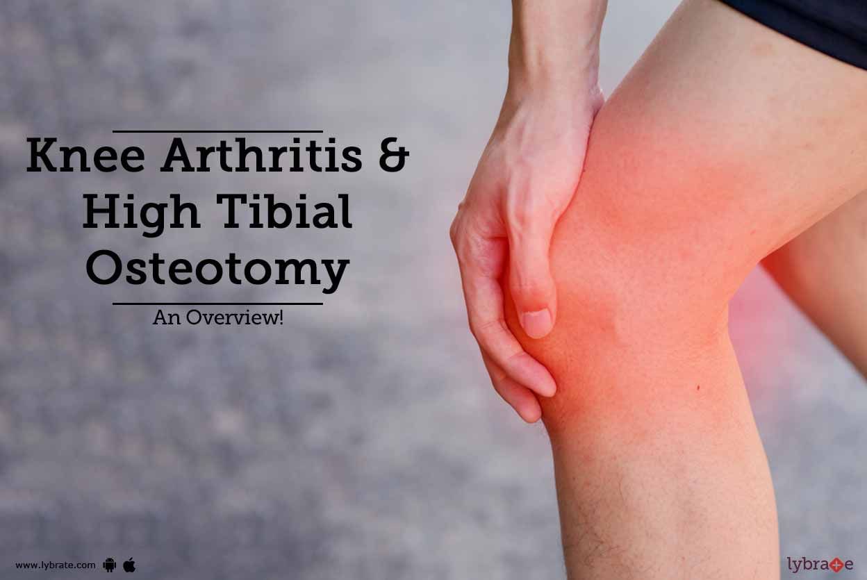 Knee Arthritis & High Tibial Osteotomy - An Overview!