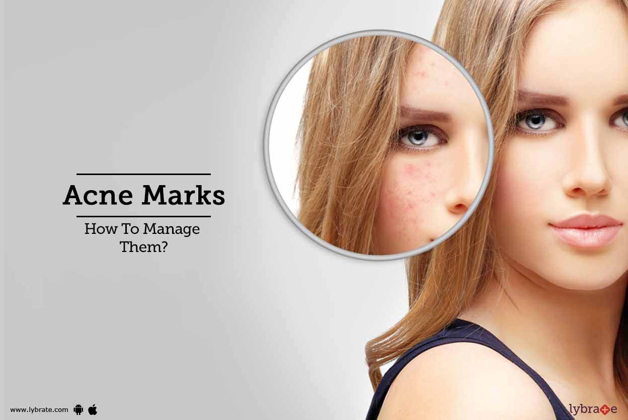 Acne Marks - How To Manage Them?