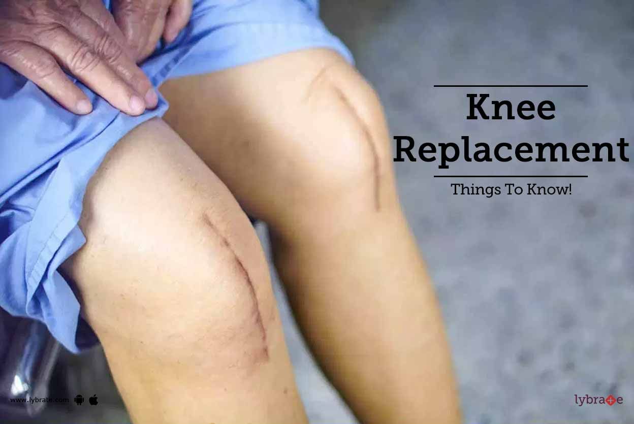 Knee Replacement - Things To Know!