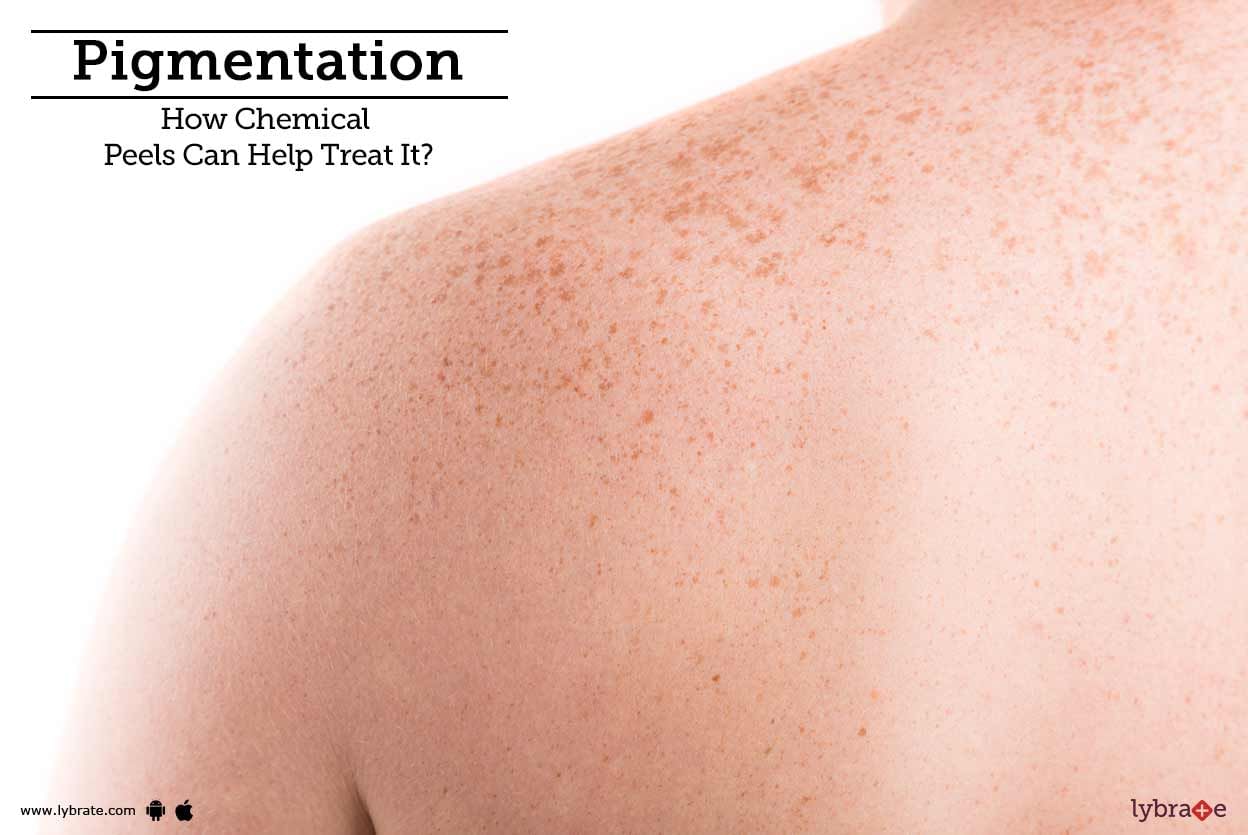 Pigmentation - How Chemical Peels Can Help Treat It?