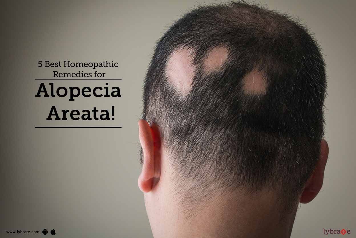 5 Best Homeopathic Remedies for Alopecia Areata!