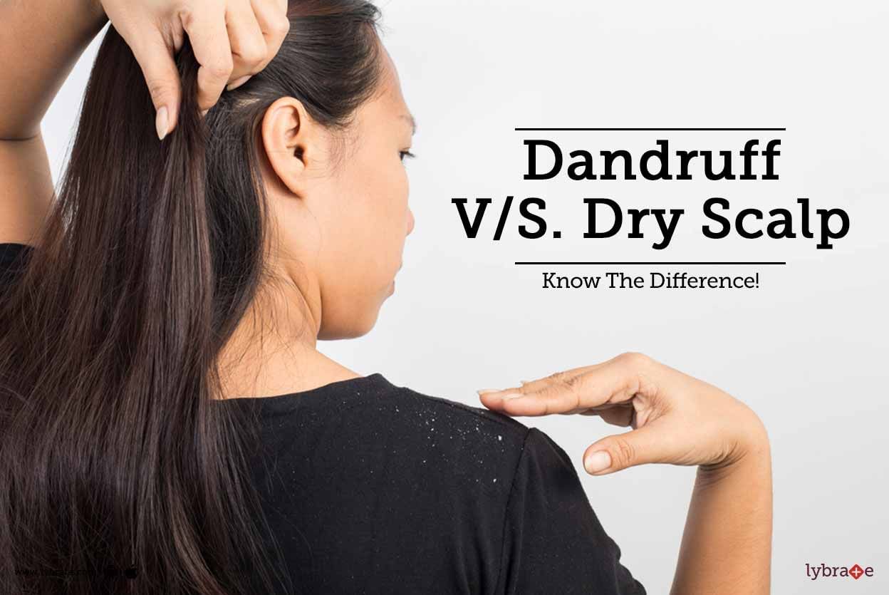 Dandruff V/S Dry Scalp - Know The Difference!