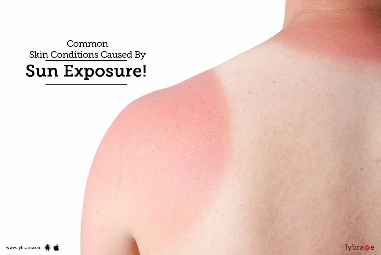 Common Skin Conditions Caused By Sun Exposure!