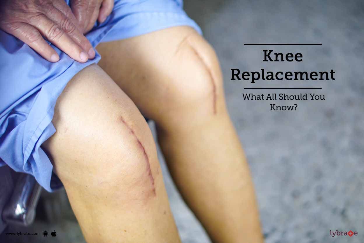 Knee Replacement - What All Should You Know?