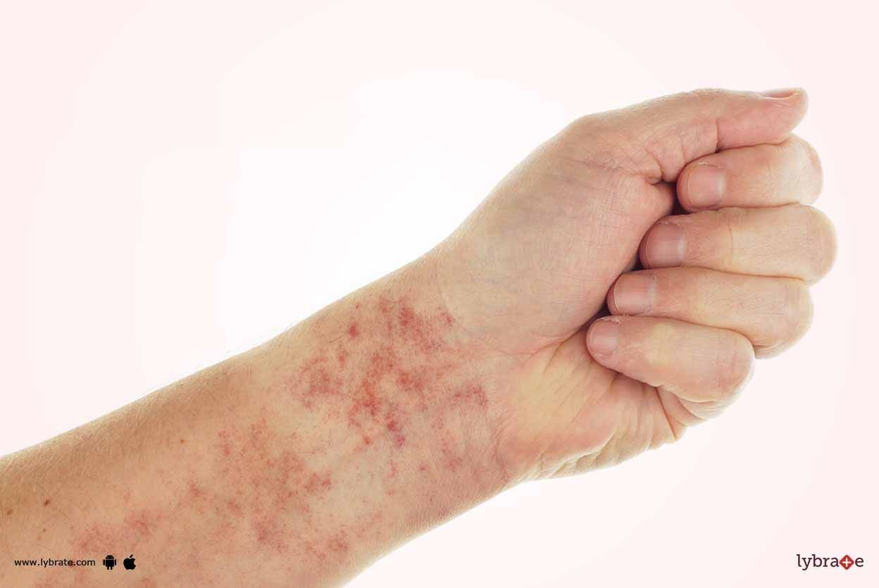 6 Symptoms Of Lichen Planus And Its Treatment!