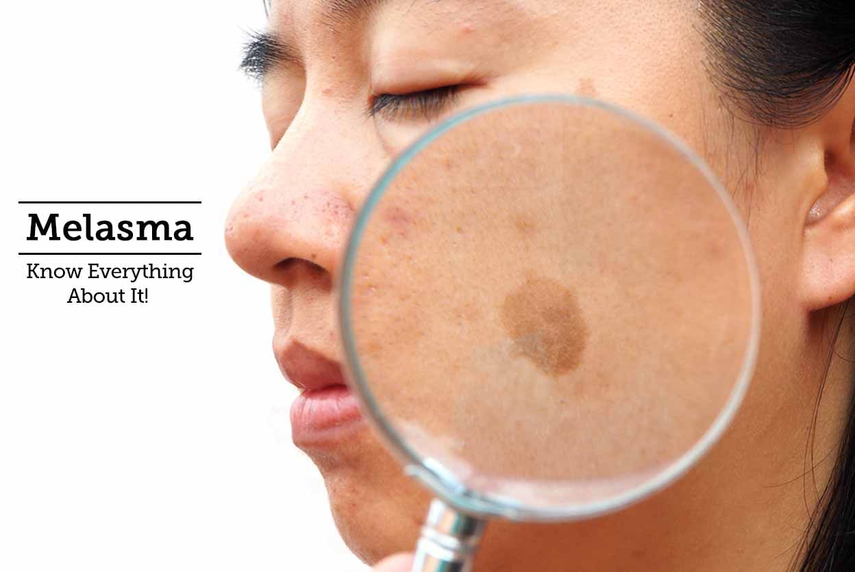 Melasma - Know Everything About It!