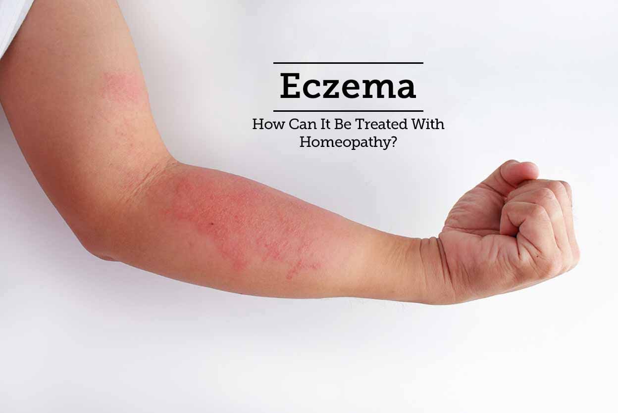 Eczema - How Can It Be Treated With Homeopathy?