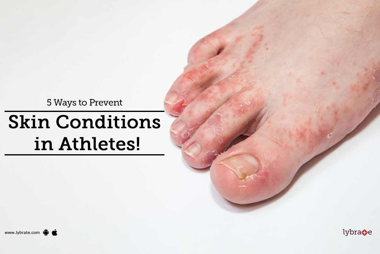 5 Ways to Prevent Skin Conditions in Athletes!