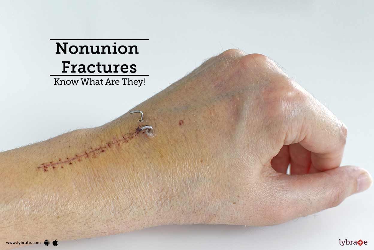 Nonunion Fractures - Know What Are They!