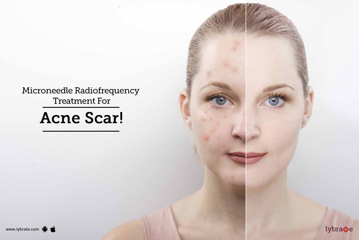 Microneedle Radiofrequency Treatment For Acne Scar!