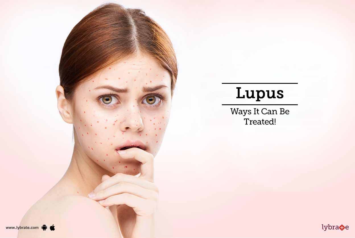 Lupus - Ways It Can Be Treated!
