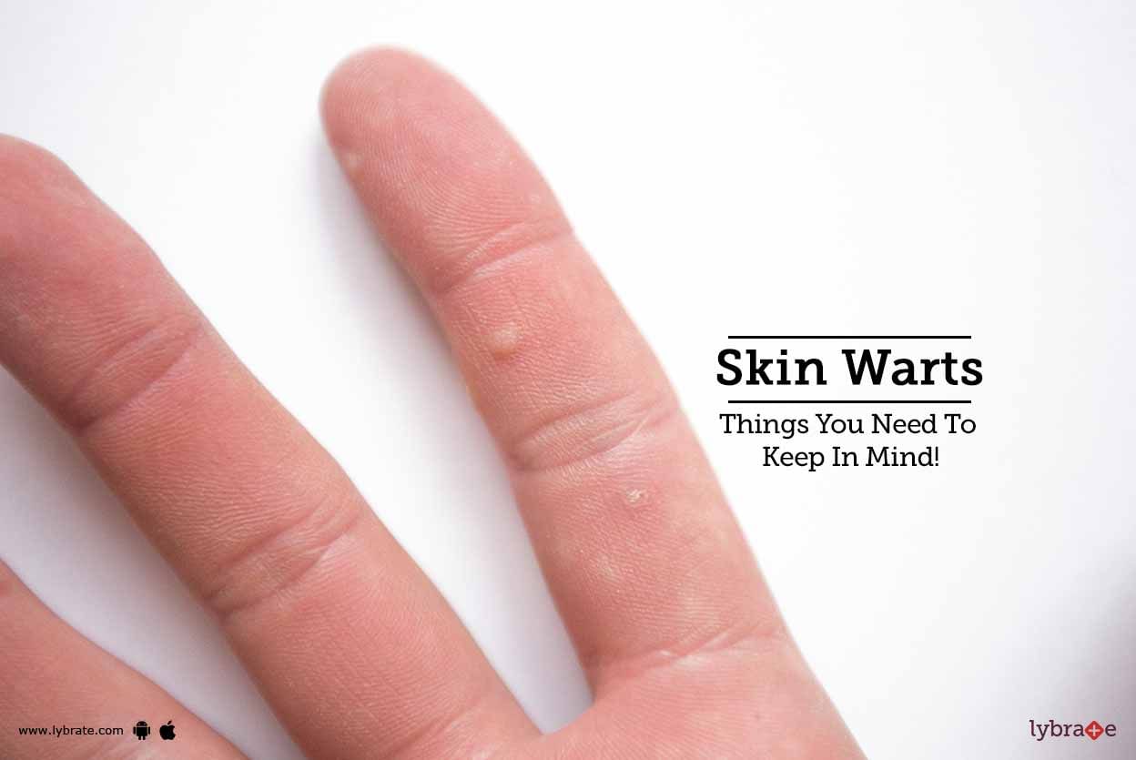 Skin Warts - Things You Need To Keep In Mind!