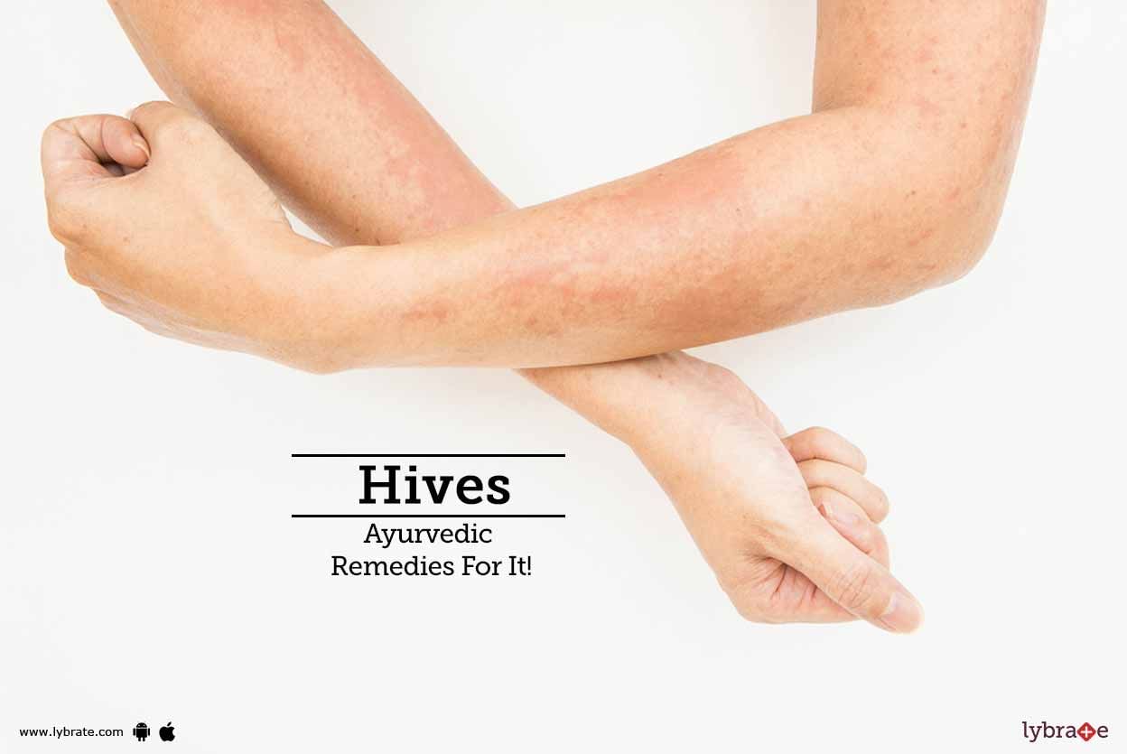 Hives - Ayurvedic Remedies For It!