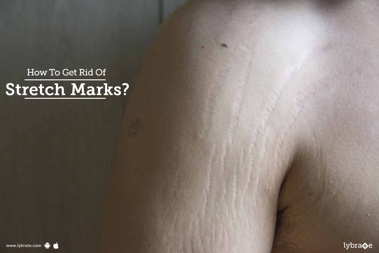 How To Get Rid Of Stretch Marks?