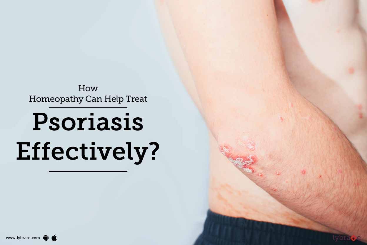 How Homeopathy Can Help Treat Psoriasis Effectively?
