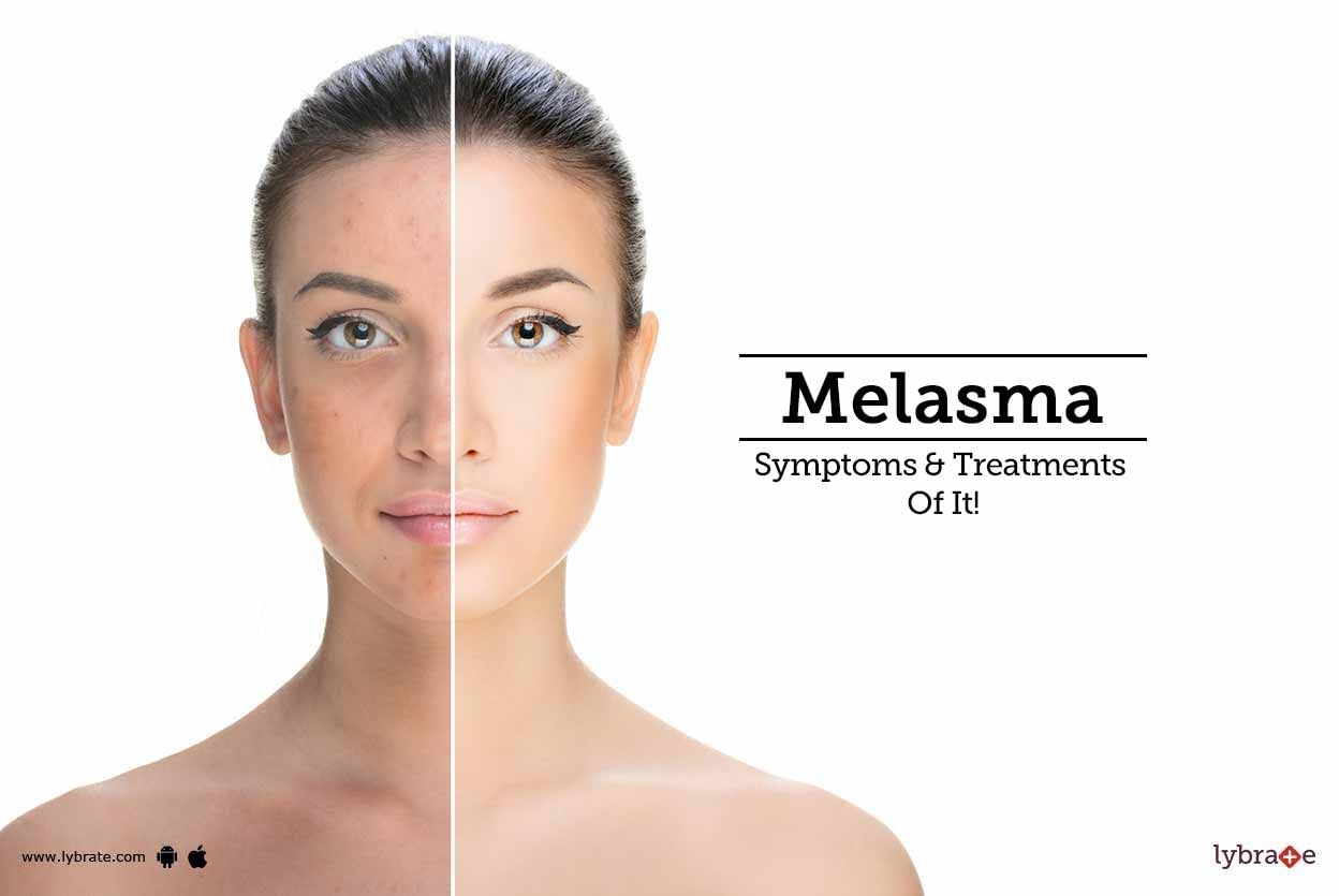 Melasma - Symptoms & Treatments Of It!