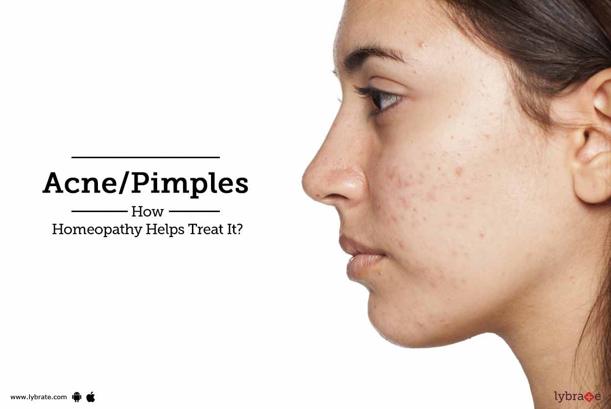 Acne/Pimples - How Homeopathy Helps Treat It?