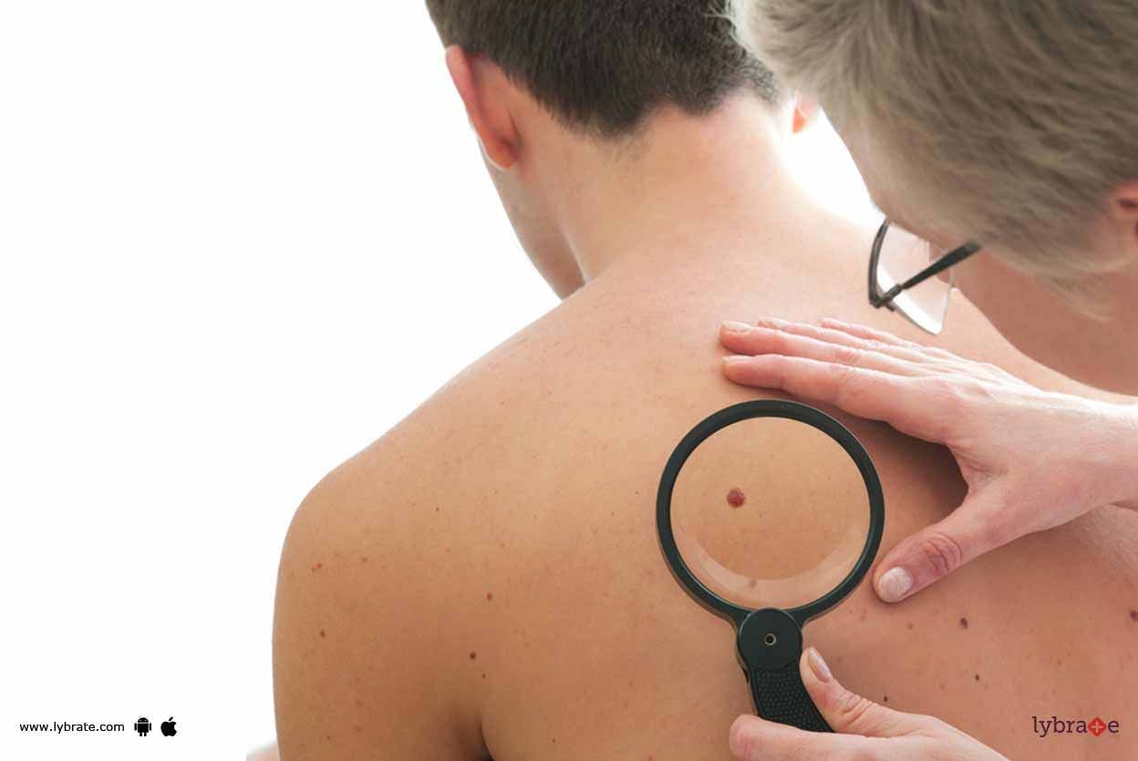 Skin Cancer - Can Fair Complexion Increase Your Risks For It!