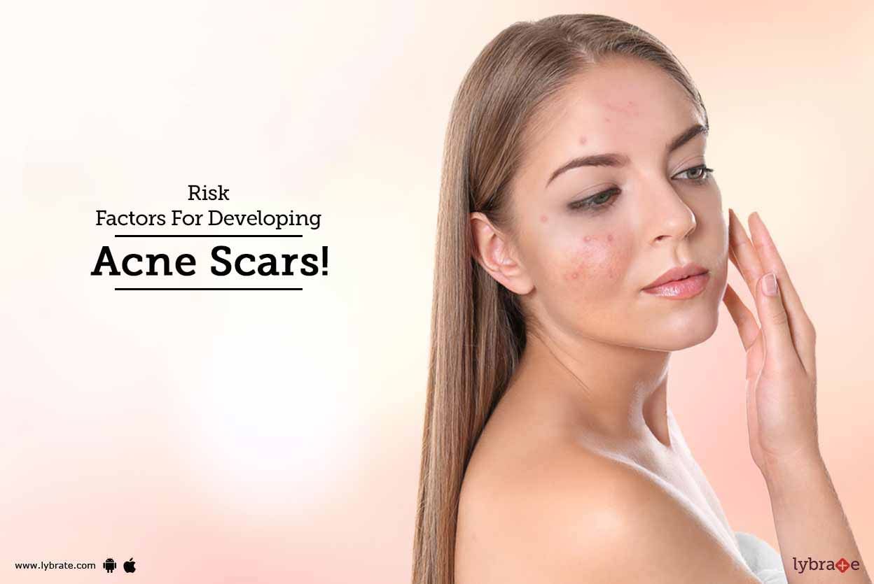 Risk Factors For Developing Acne Scars!