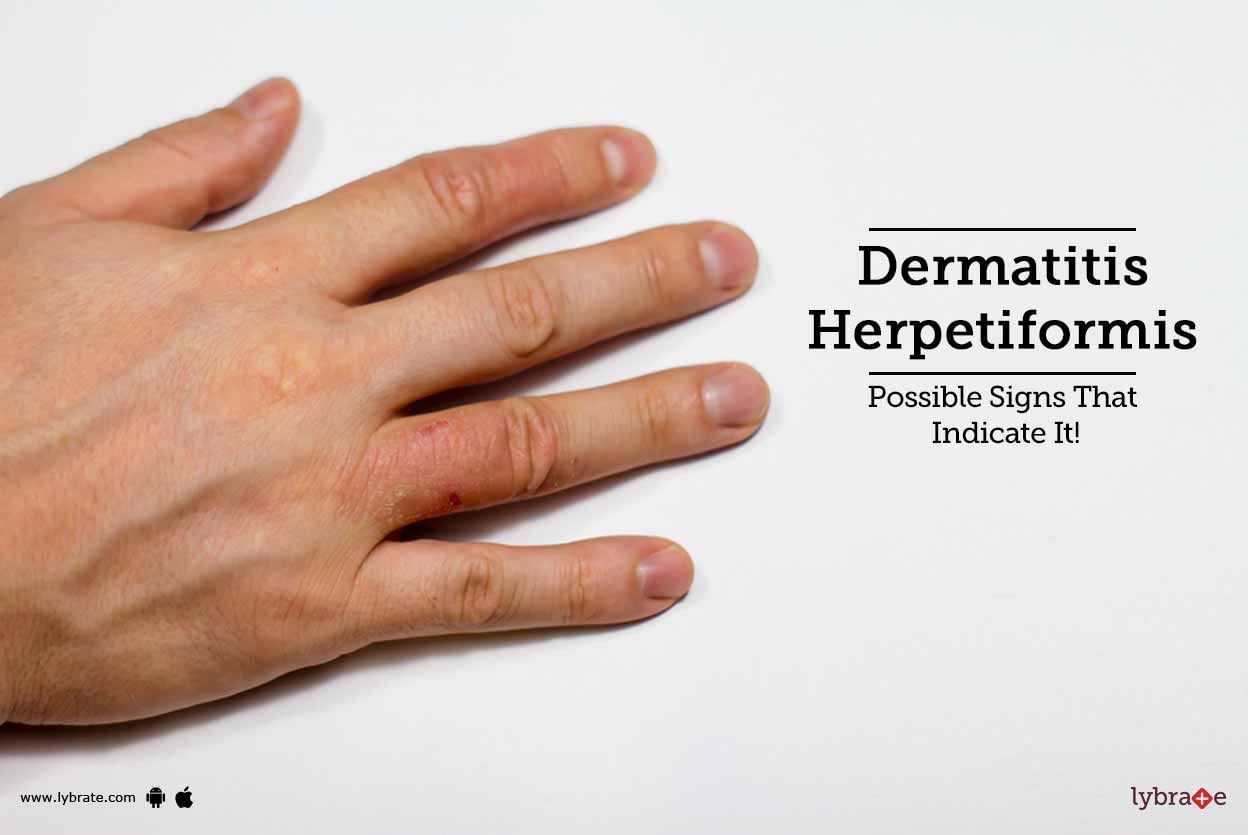 Dermatitis Herpetiformis - Possible Signs That Indicate It!