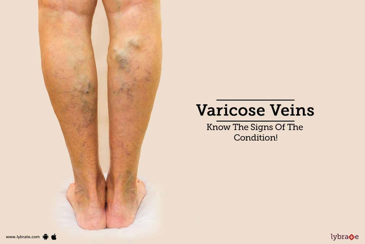 Varicose Veins - Know The Signs Of The Condition!