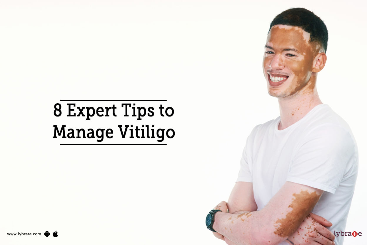 8 Expert Tips To Manage Vitiligo
