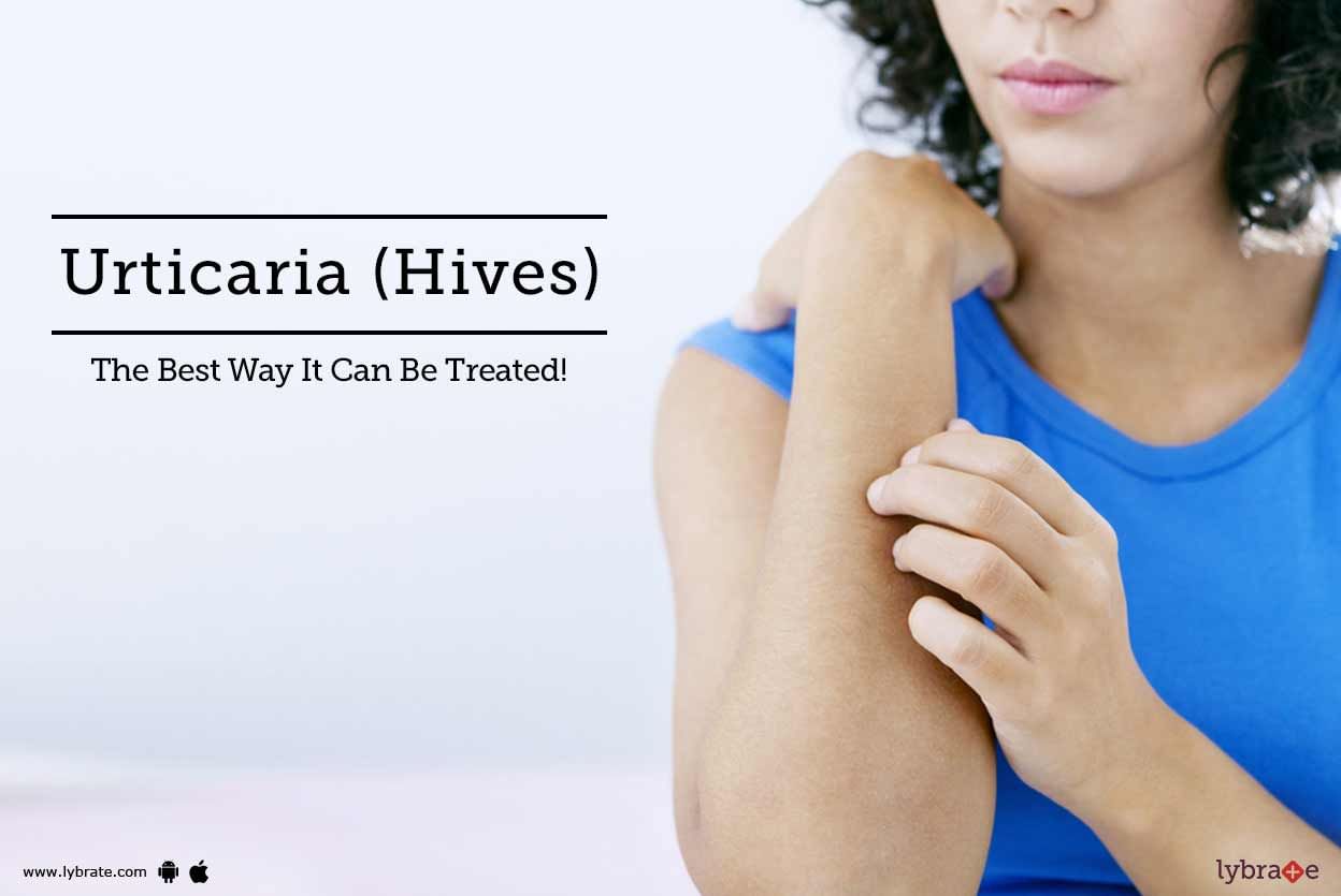 Urticaria (Hives) - The Best Way It Can Be Treated!