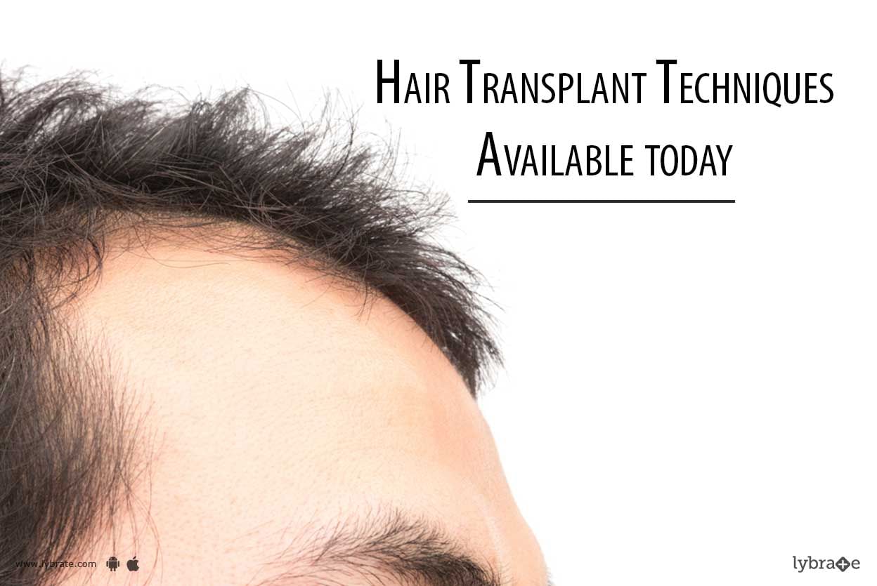 Hair Transplant Techniques Available today
