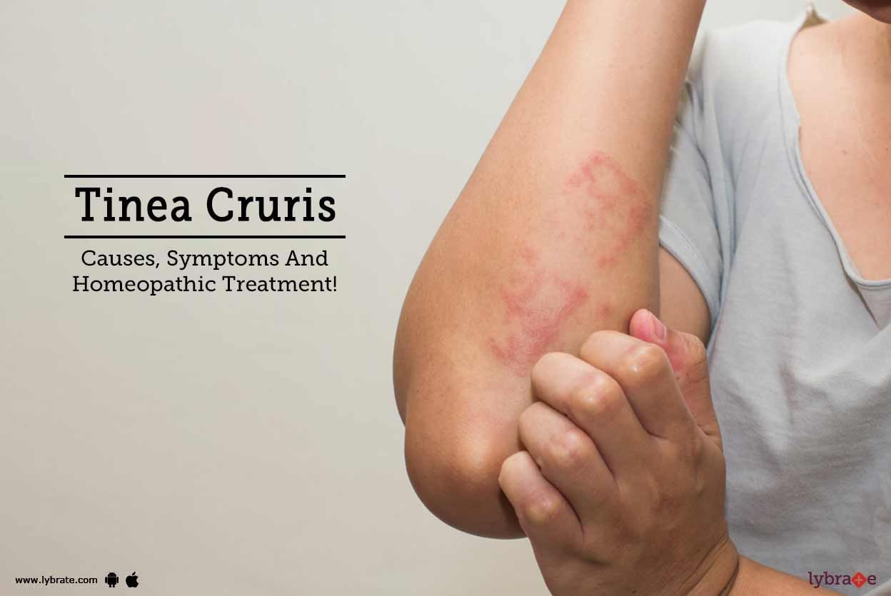 Tinea Cruris - Causes, Symptoms And Homeopathic Treatment!