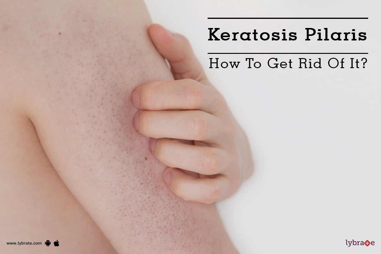 Keratosis Pilaris - How To Get Rid Of It?