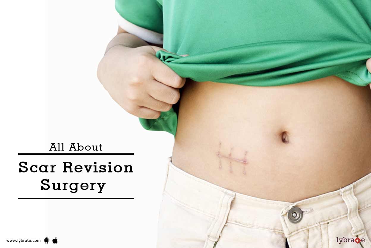 All About Scar Revision Surgery