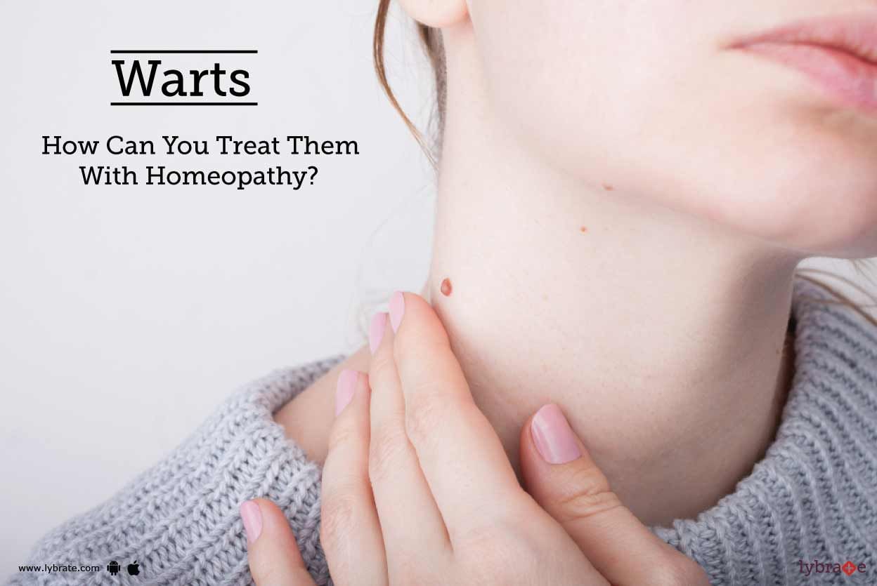 Warts - How Can You Treat Them With Homeopathy?