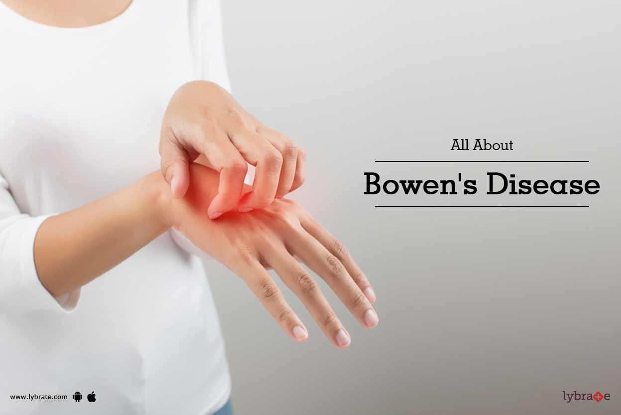 All About Bowen's Disease