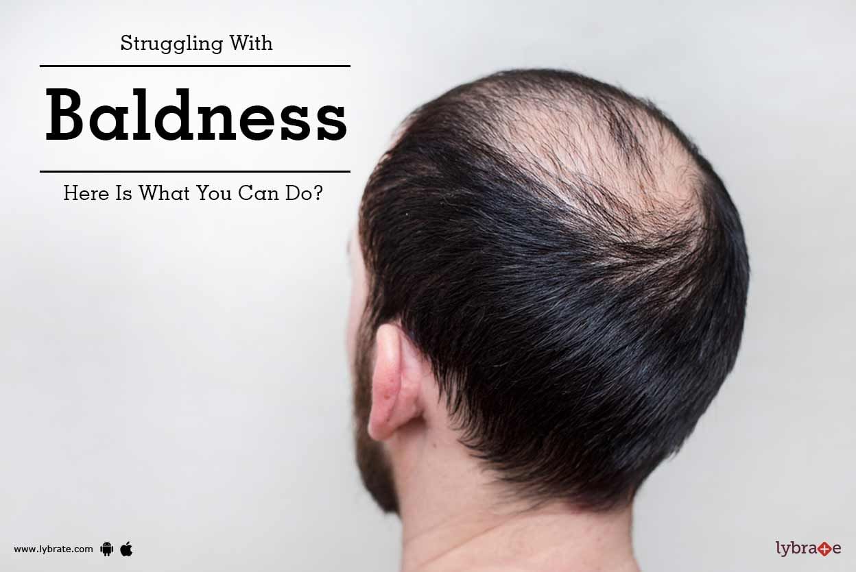 Struggling With Baldness - Here Is What You Can Do?