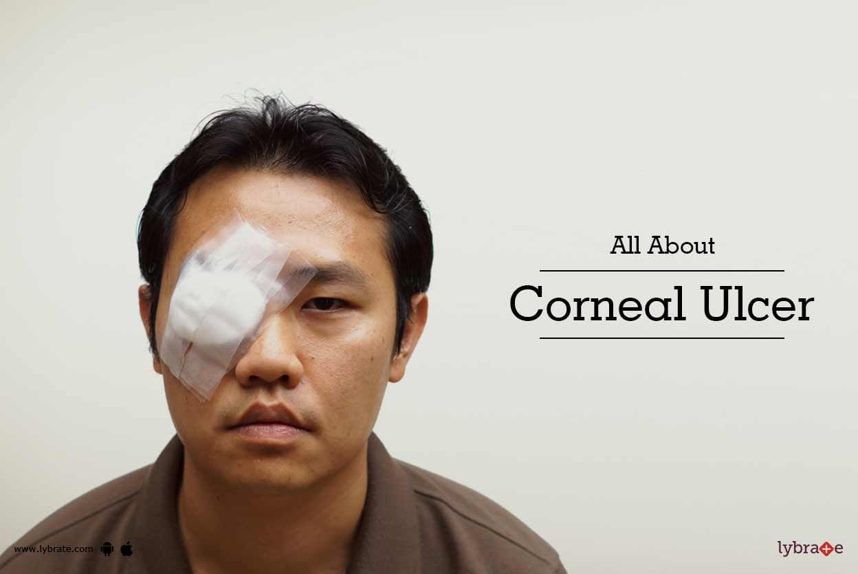 All About Corneal Ulcer
